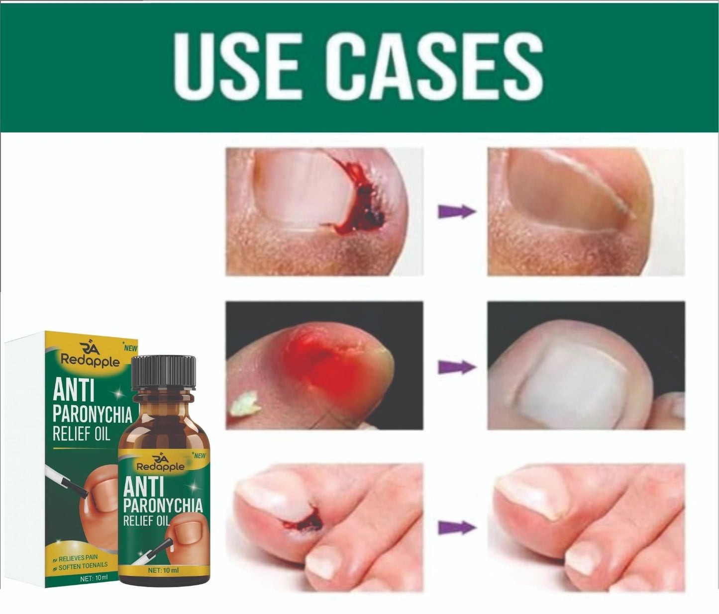 Anti Paronychia Relief Oil 20 ml Pack of 2